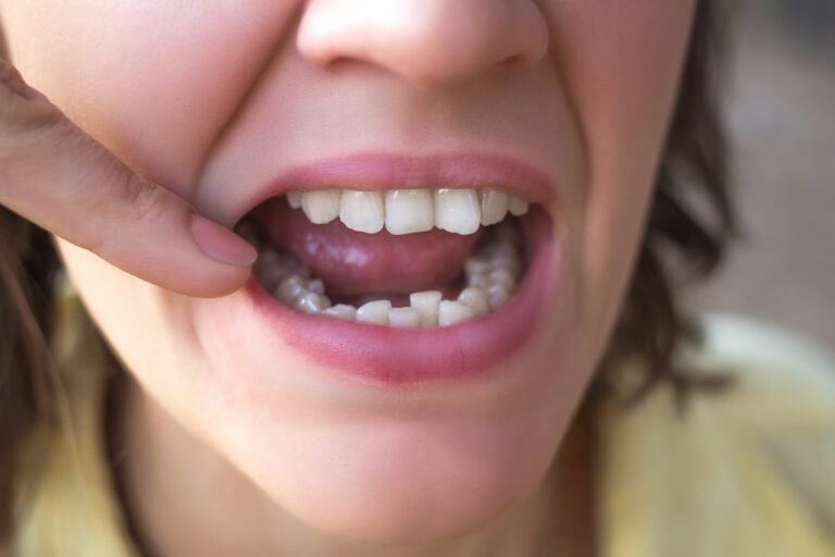 Struggling with Misaligned Teeth? Try Invisalign in El Dorado Hills