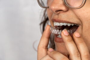 Can You Really Clean Your Retainer or Aligner in an Ultrasonic Cleaner? What Dentists Want You to Know